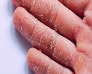 Làm Thế Nào Để Điều Trị Khi Tay Bị Tróc Da?