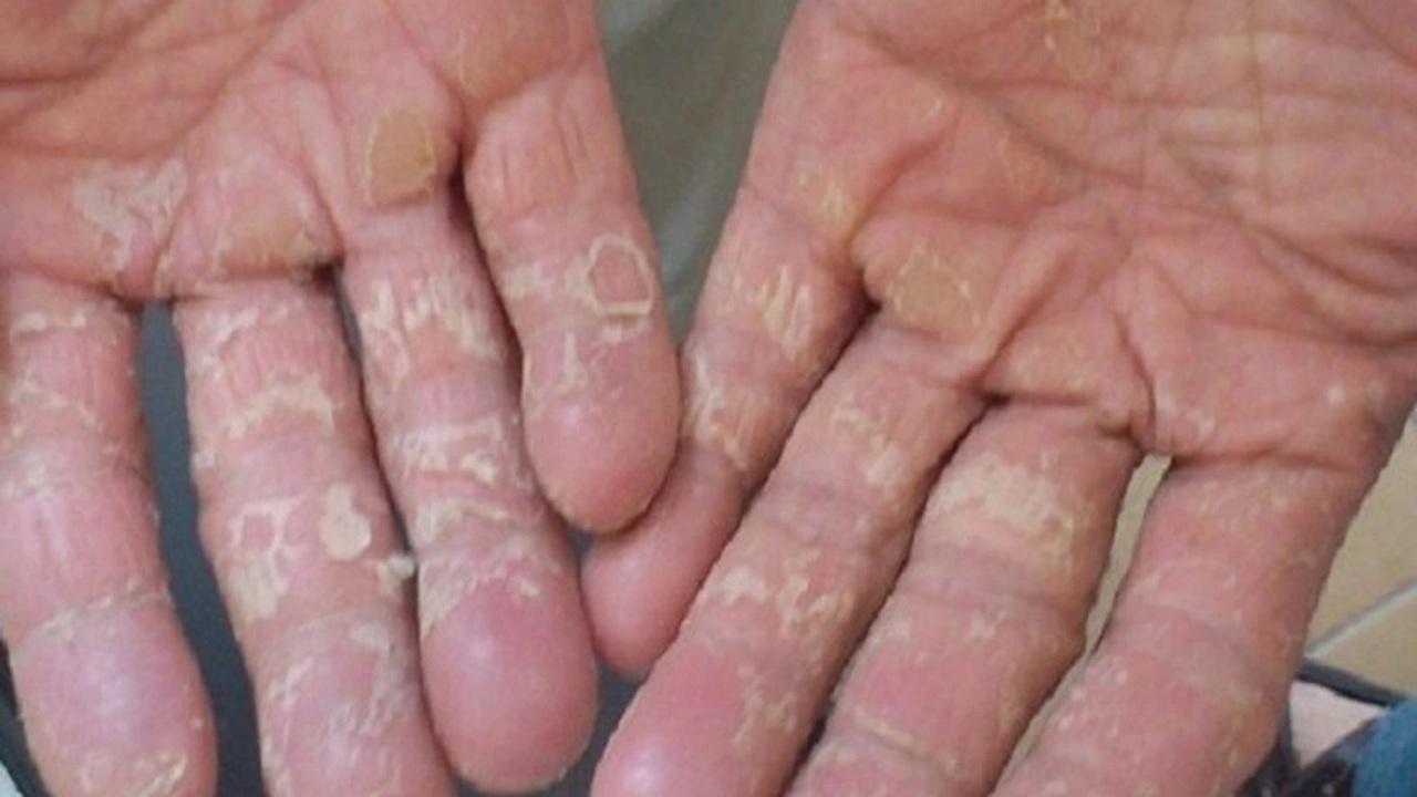 da tay bị bong tróc