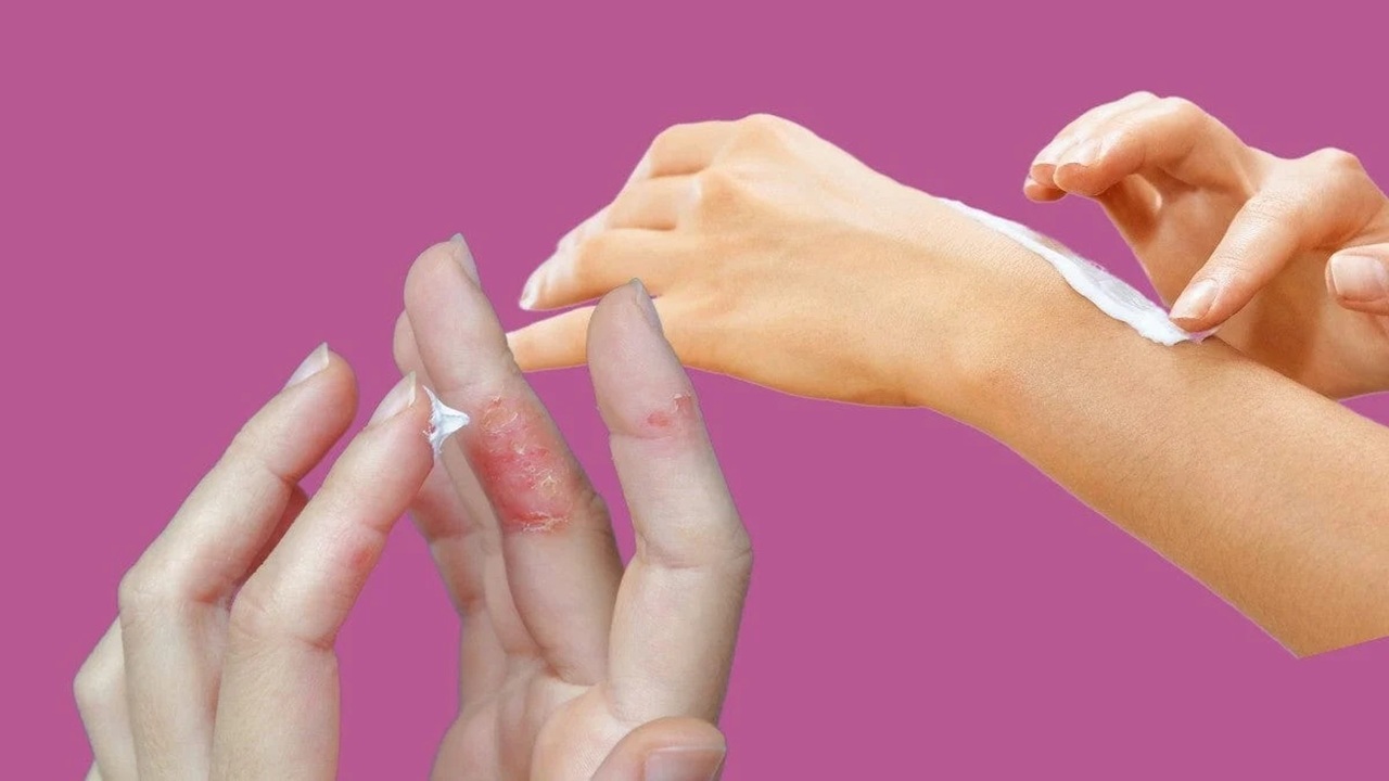 da tay bị bong tróc