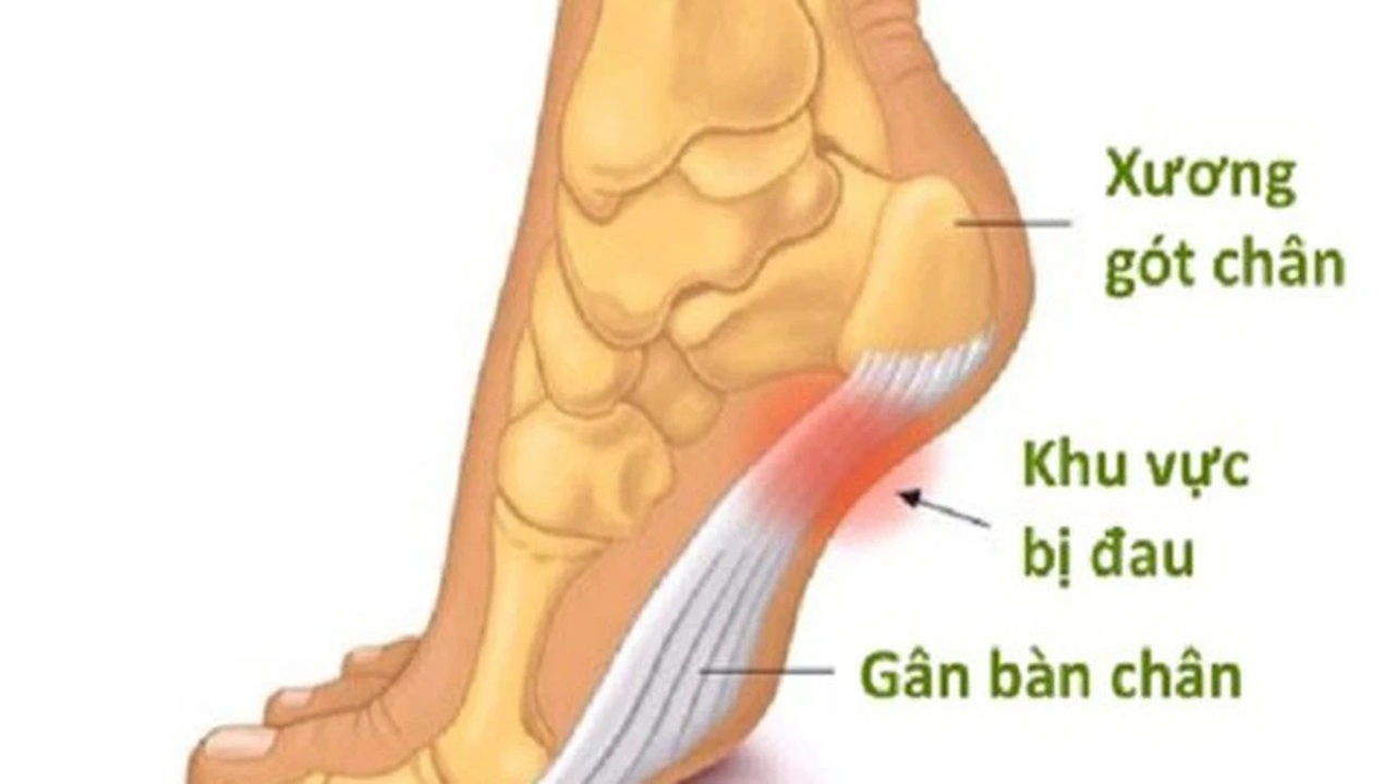 đau gót chân