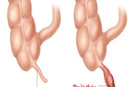 Nhận Biết Sớm Dấu Hiệu Đau Ruột Thừa: Cảnh Báo và Điều Cần Lưu Ý