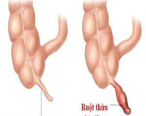 Nhận Biết Sớm Dấu Hiệu Đau Ruột Thừa: Cảnh Báo và Điều Cần Lưu Ý