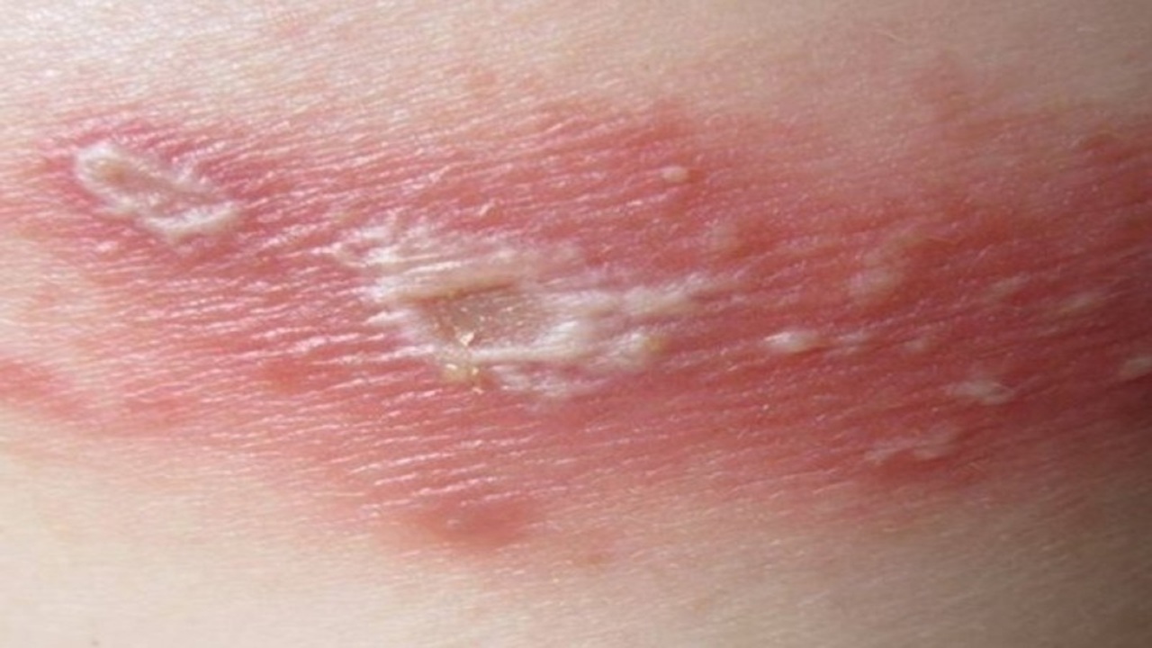 kiến ba khoang cắn