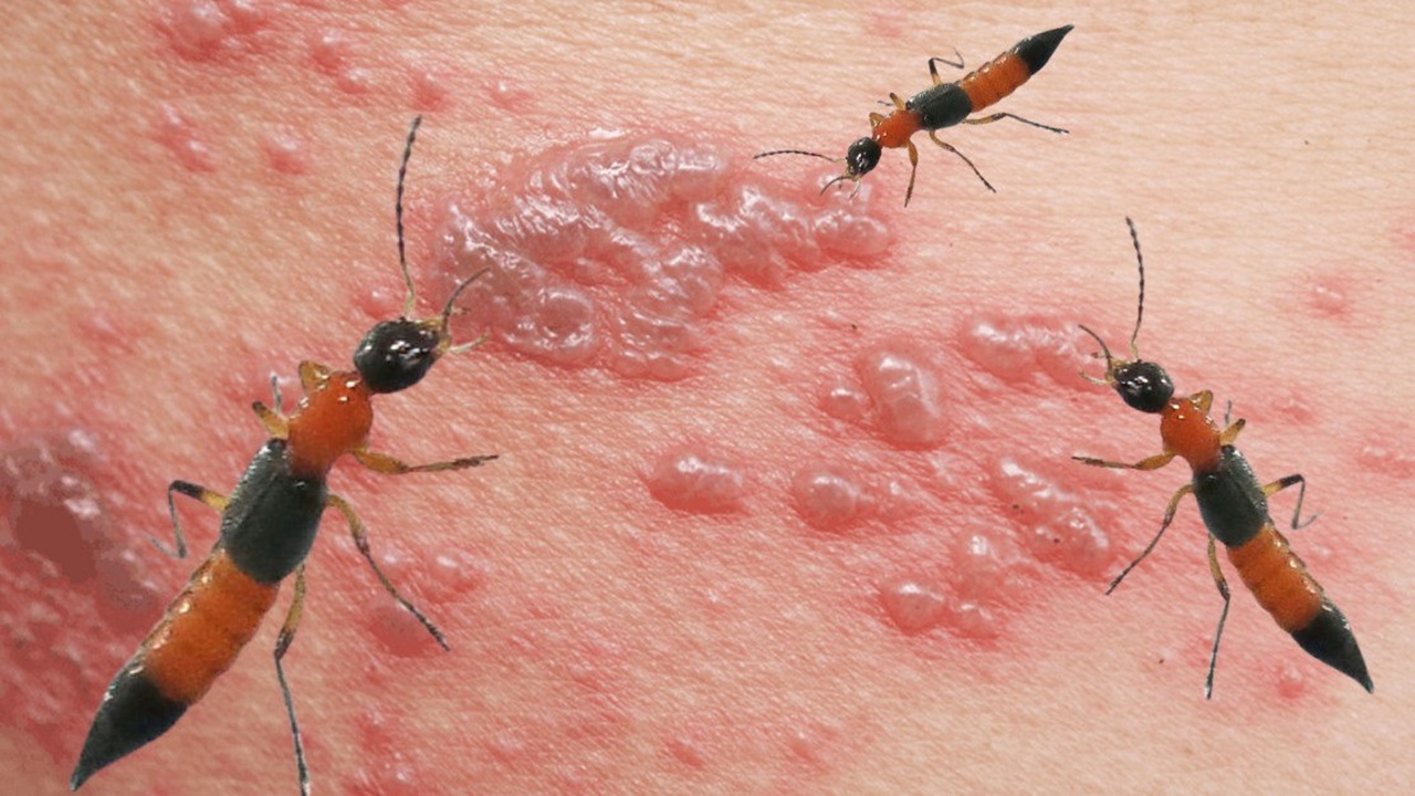 kiến ba khoang cắn