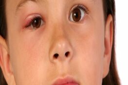 Lẹo Mắt Là Gì? Nguyên Nhân, Triệu Chứng và Biện Pháp Điều Trị