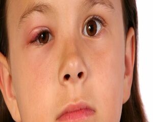 Lẹo Mắt Là Gì? Nguyên Nhân, Triệu Chứng và Biện Pháp Điều Trị
