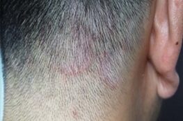 Nấm Da Đầu: Những Điều Cần Biết về Nguyên Nhân, Triệu Chứng và Phòng Ngừa