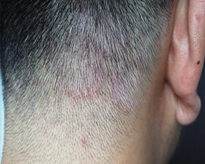 Nấm Da Đầu: Những Điều Cần Biết về Nguyên Nhân, Triệu Chứng và Phòng Ngừa