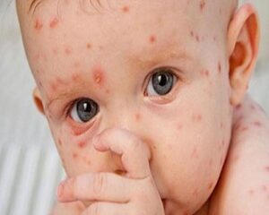 Nhiễm Trùng Máu: Nguyên Nhân, Biểu Hiện Và Cách Nhận Biết