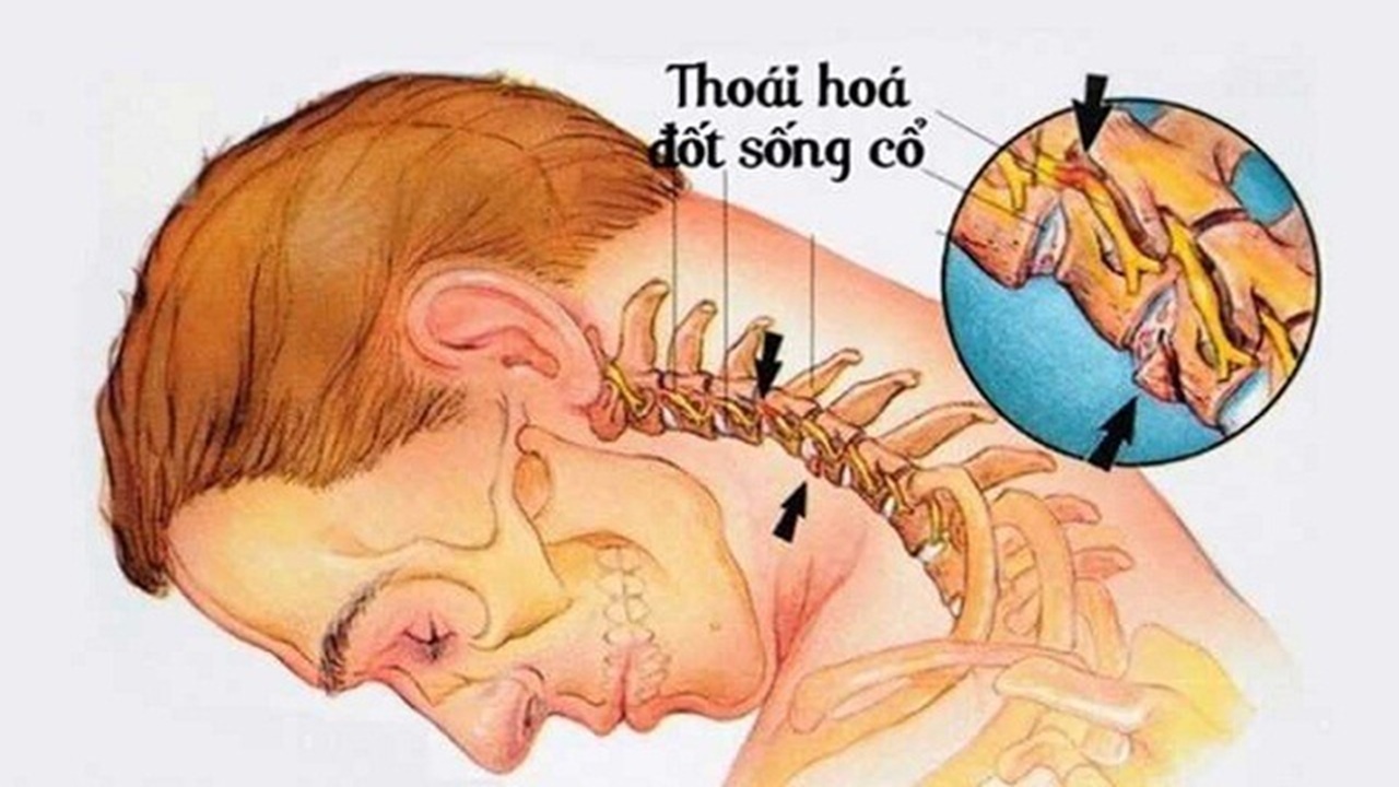thoái hóa đốt sống cổ
