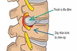 Hiểu Biết Về Thoát Vị Đĩa Đệm: Nguyên Nhân và Triệu Chứng