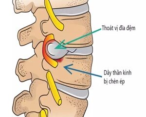 Hiểu Biết Về Thoát Vị Đĩa Đệm: Nguyên Nhân và Triệu Chứng