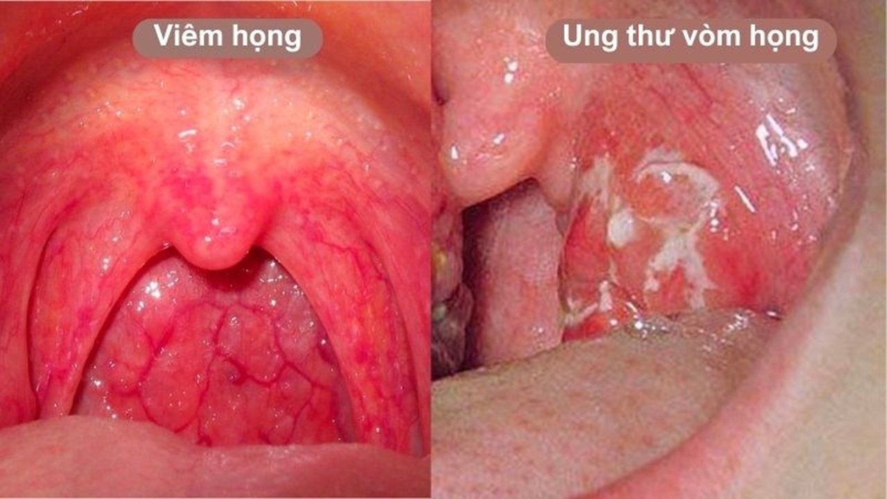 ung thư vòm họng