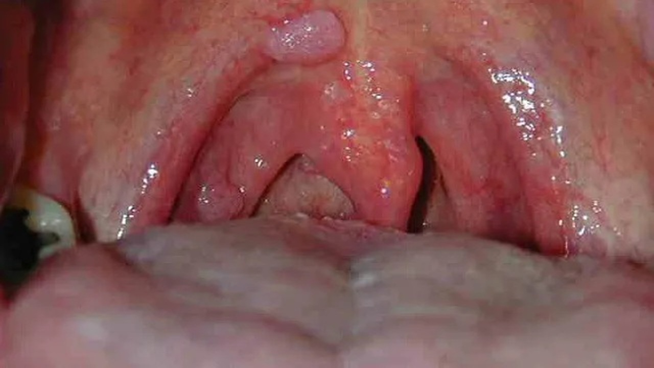 ung thư vòm họng