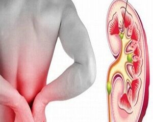 Tìm Hiểu Về Sỏi Thận: Nguyên Nhân, Các Triệu Chứng và Phương Pháp Điều Trị