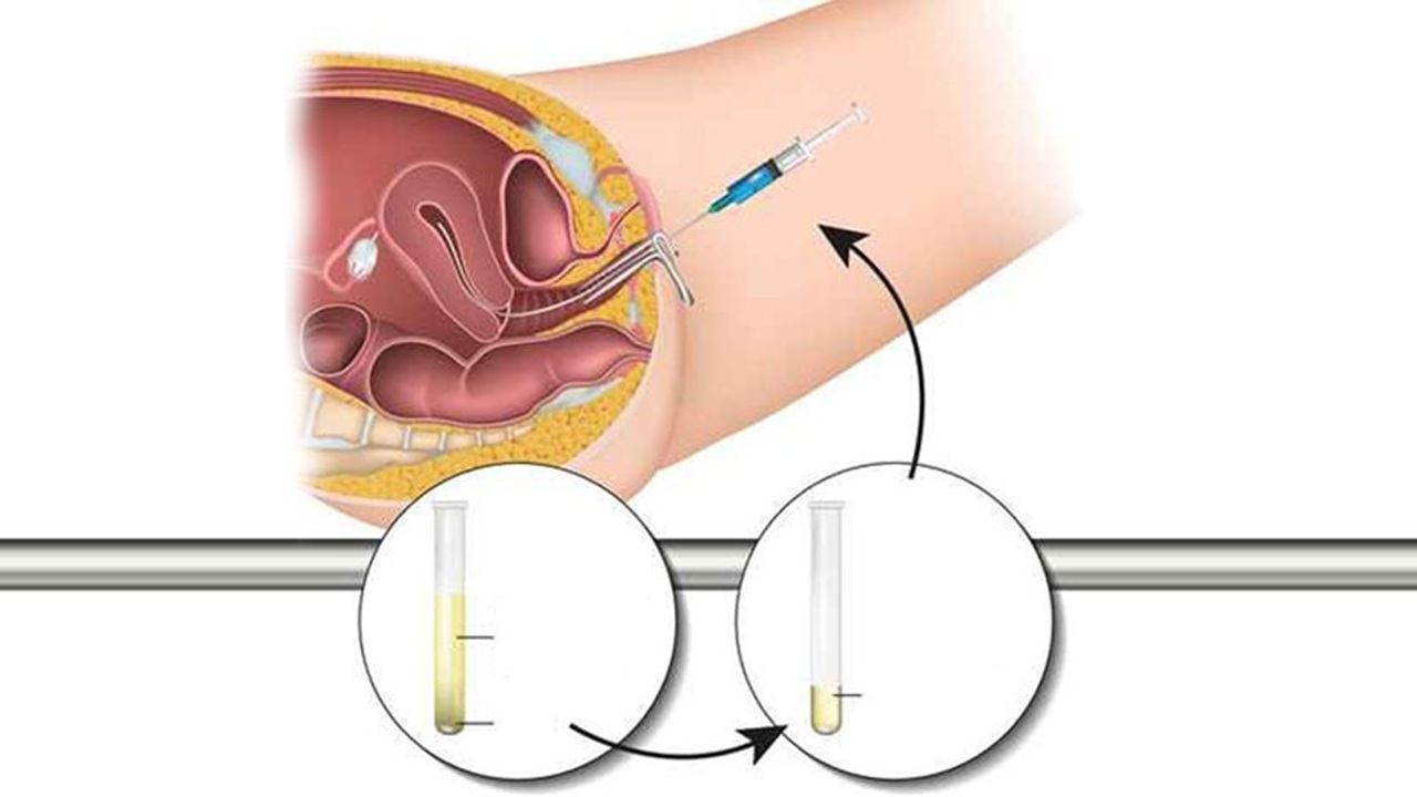 bao lâu thì tinh trùng vào tử cung