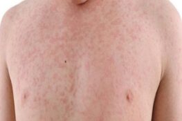 Tăng Cường Kiến Thức Về Bệnh Sởi Tầm Quan Trọng Của Vắc Xin