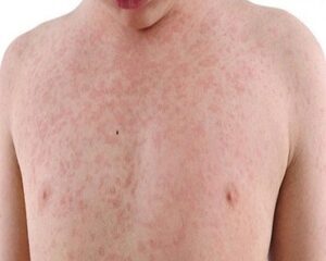 Tăng Cường Kiến Thức Về Bệnh Sởi Tầm Quan Trọng Của Vắc Xin