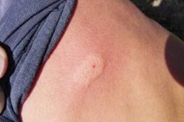 Bị rết cắn có sao không 3 bước xử lý nhanh tại nhà ai cũng cần biết