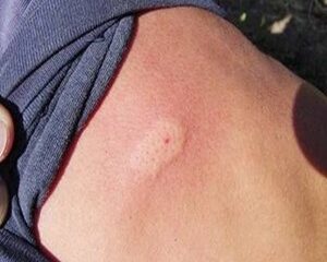 Bị rết cắn có sao không 3 bước xử lý nhanh tại nhà ai cũng cần biết