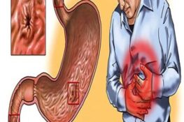 Đau Dạ Dày: Nguyên Nhân, Triệu Chứng Và Cách Phòng Ngừa