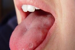 Nhiệt Lưỡi Là Gì? Nguyên Nhân Và Cách Khắc Phục Hiệu Quả Tại Nhà