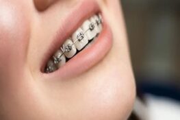 Niềng Răng: Hành Trình Thay Đổi Nụ Cười và Cuộc Sống