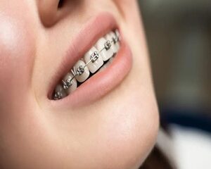 Niềng Răng: Hành Trình Thay Đổi Nụ Cười và Cuộc Sống