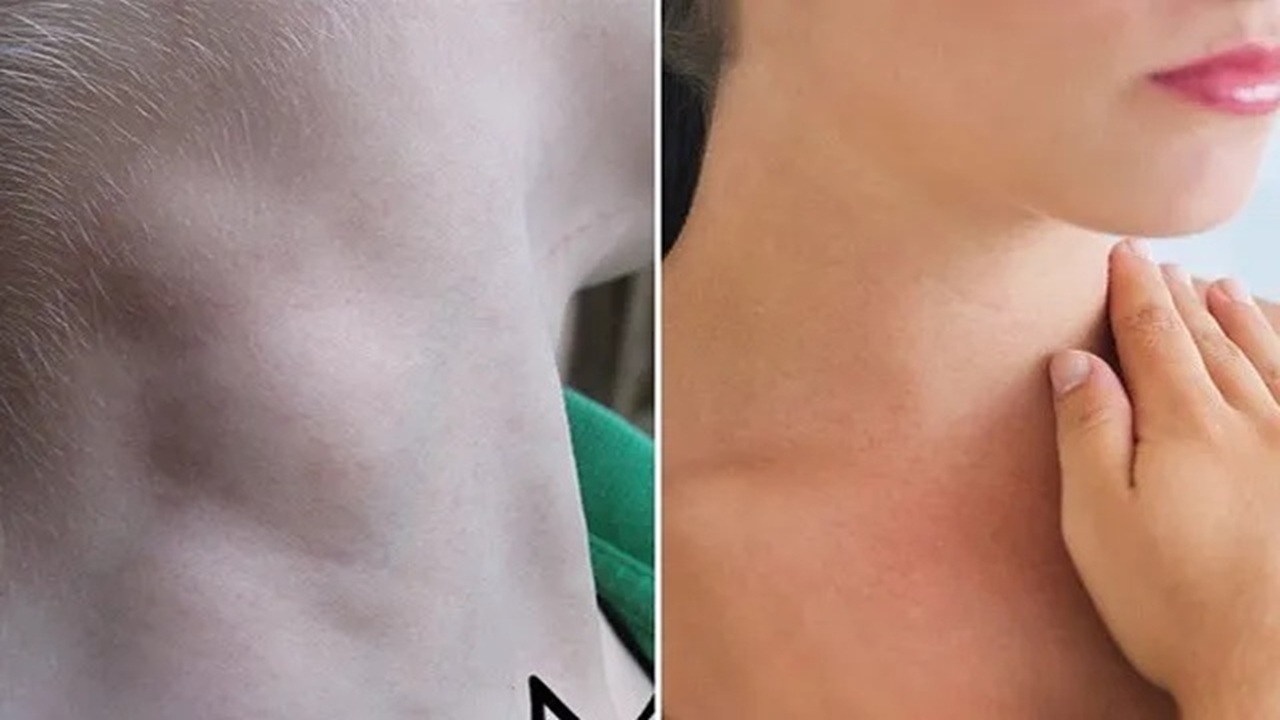 nổi hạch ở cổ