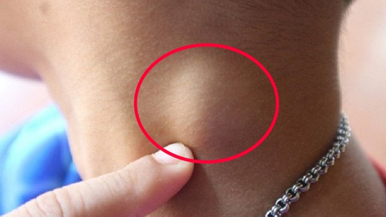 nổi hạch ở cổ