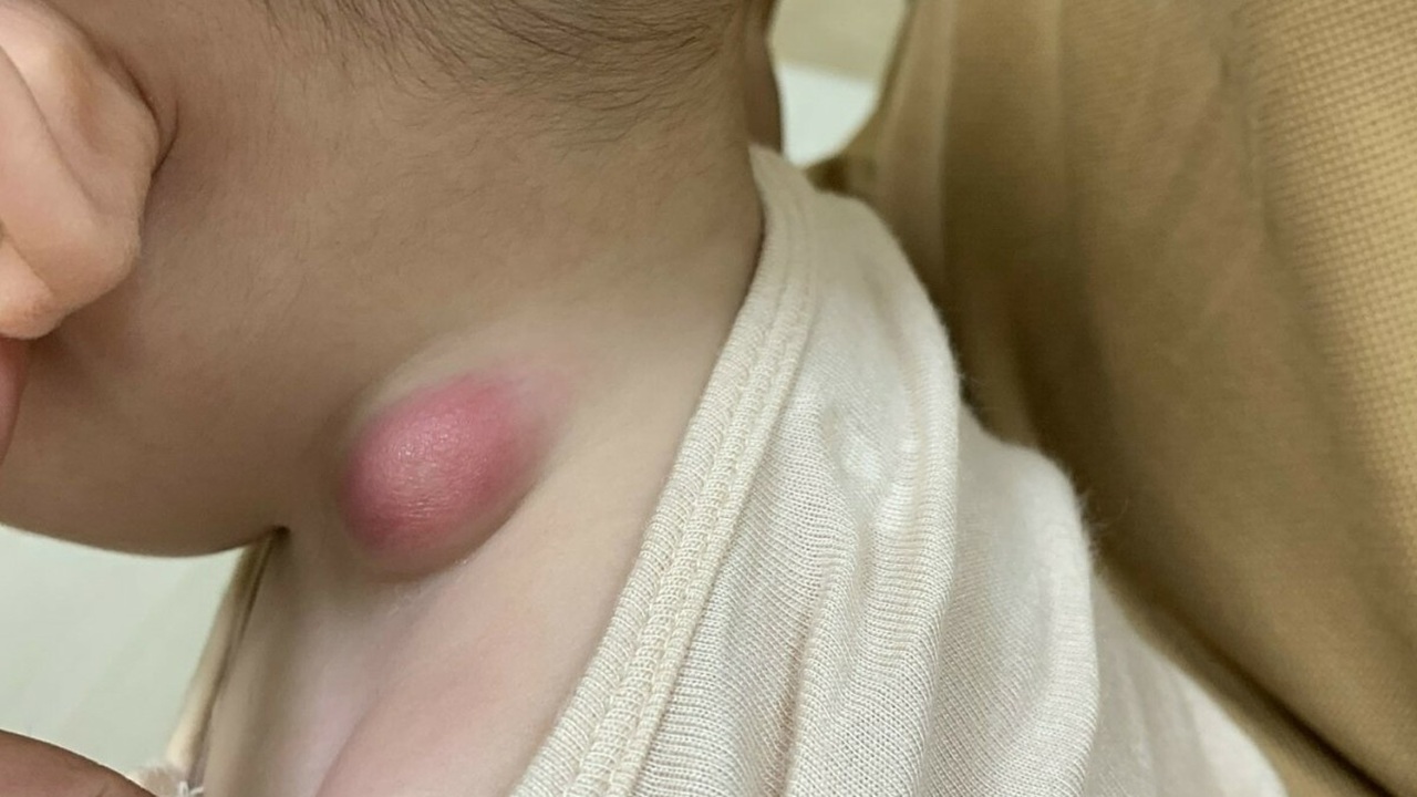 nổi hạch ở cổ