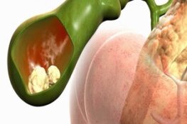 Tất Tần Tật Về Polyp Túi Mật: Nguyên Nhân, Triệu Chứng và Cách Điều Trị