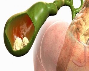 Tất Tần Tật Về Polyp Túi Mật: Nguyên Nhân, Triệu Chứng và Cách Điều Trị