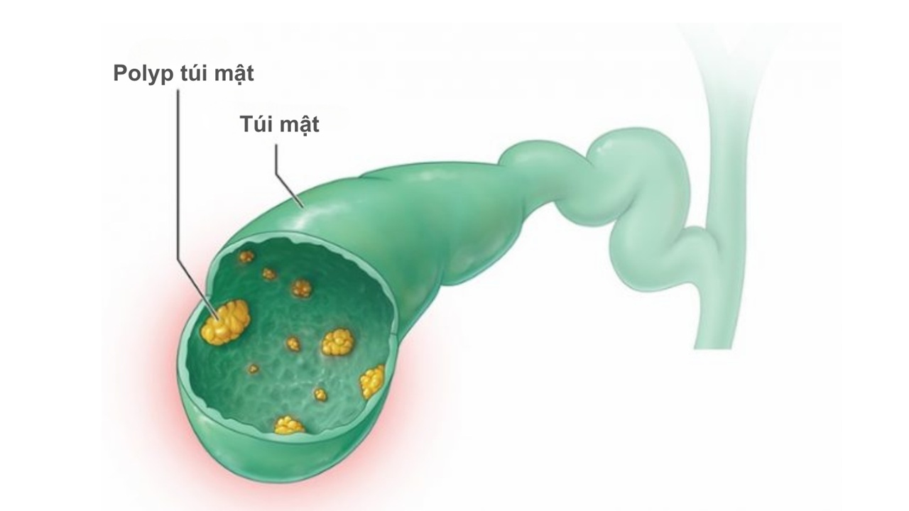 polyp túi mật