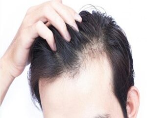 Rụng tóc không phải chuyện tuổi già – Cảnh báo sớm để kịp cứu mái tóc!