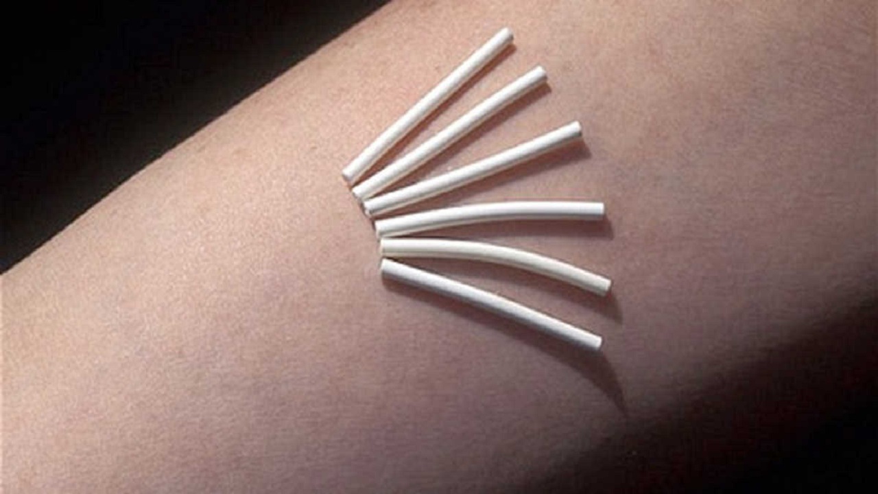 những người không nên cấy que tránh thai