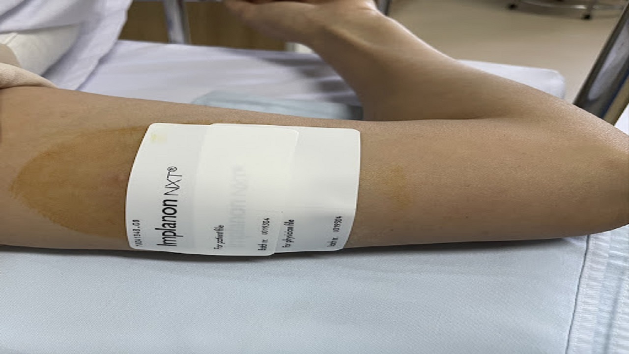 những người không nên cấy que tránh thai