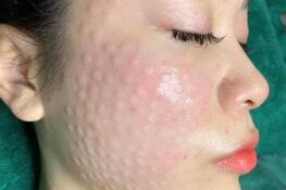 Tiêm Meso Có Tốt Không? Những Điều Cần Biết Trước Khi Thực Hiện