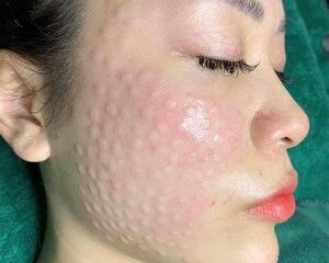 Tiêm Meso Có Tốt Không? Những Điều Cần Biết Trước Khi Thực Hiện