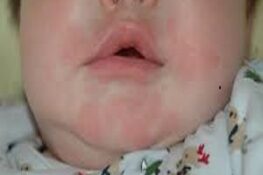 Trẻ bị dị ứng tắm lá gì để giảm ngứa, mẩn đỏ hiệu quả?