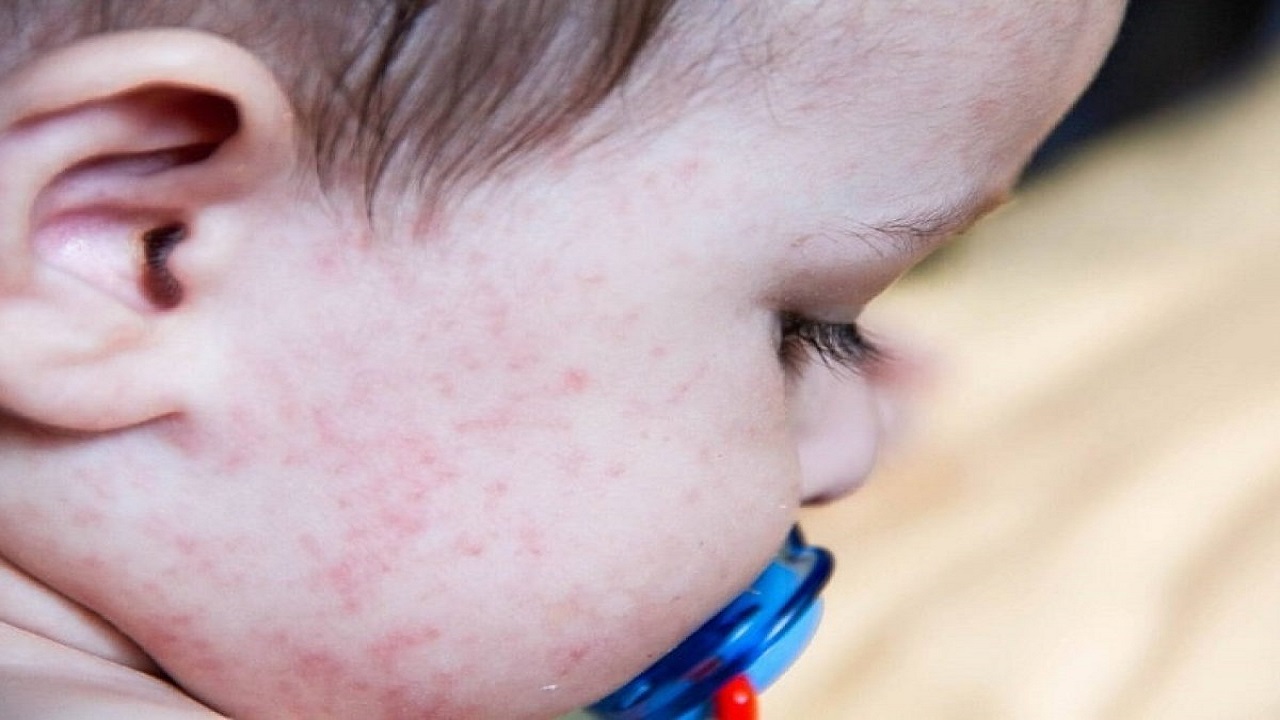 trẻ bị ngứa tắm lá gì