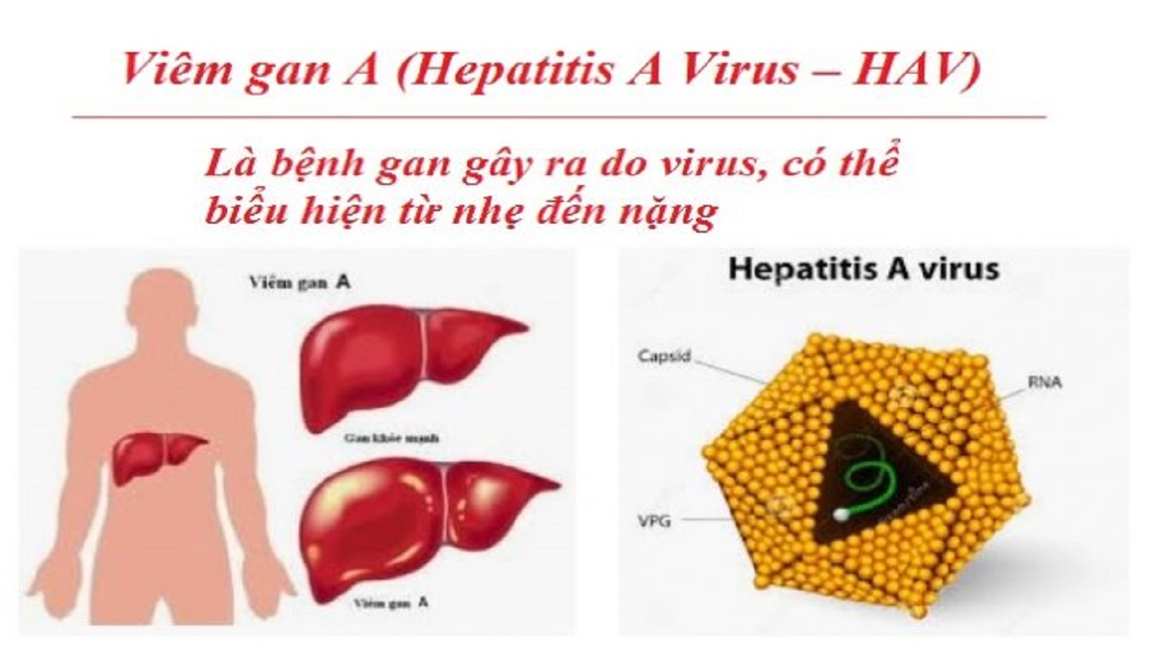 viêm gan a