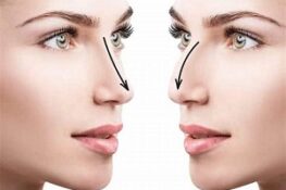 Nâng Mũi Có An Toàn Lâu Dài Không? Hậu Quả Khi Về Già Bạn Nên Biết