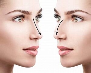 Nâng Mũi Có An Toàn Lâu Dài Không? Hậu Quả Khi Về Già Bạn Nên Biết