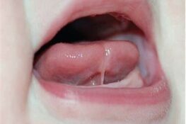 Nguyên Nhân Khiến Trẻ 1 Tuổi Chưa Mọc Răng Và Cách Xử Lý