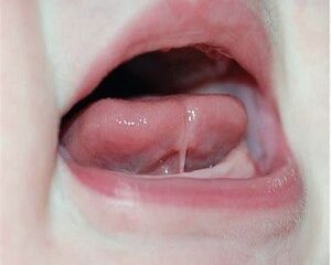 Nguyên Nhân Khiến Trẻ 1 Tuổi Chưa Mọc Răng Và Cách Xử Lý