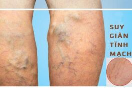 Giãn tĩnh mạch: Nguyên nhân, dấu hiệu và cách phòng ngừa hiệu quả