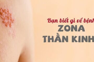 Zona thần kinh: Nguyên nhân, triệu chứng và cách điều trị hiệu quả