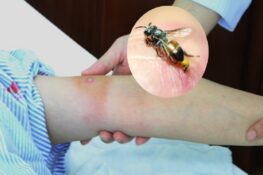 Bị ong đốt nên làm gì? Cách xử lý nhanh và an toàn tại nhà