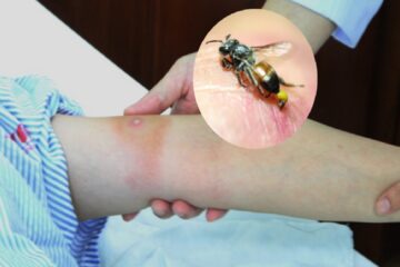 Bị ong đốt nên làm gì? Cách xử lý nhanh và an toàn tại nhà